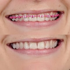 Braces Removal