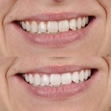 Teeth Whitening
